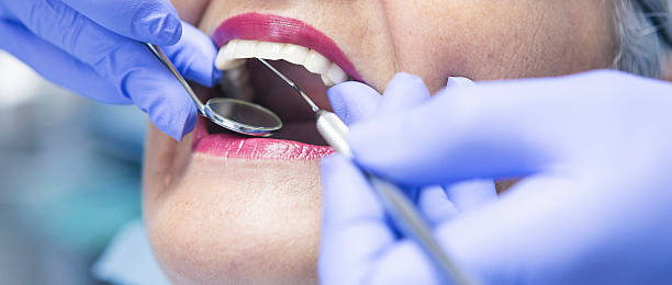 Best Lost Filling or Crown Replacement in Maurice, LA
